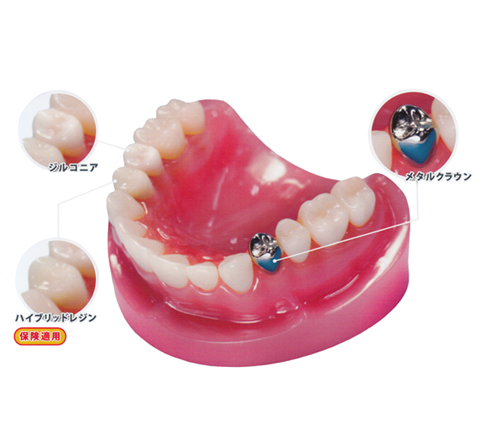 製品詳細「デントマスター CAD/CAM冠 保険比較説明模型」 | フォルディ