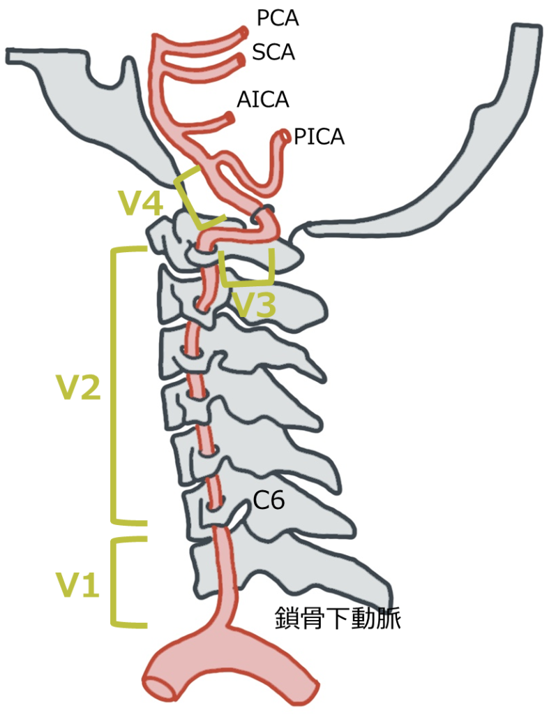 椎骨動脈解離 Vertebral Artery Dissection│医學事始 いがくことはじめ