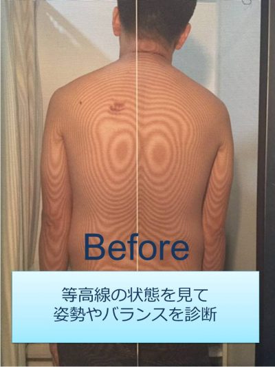 モアレグラフィー検査で身体の歪みをチェック｜J-CLINIC 理学療法科