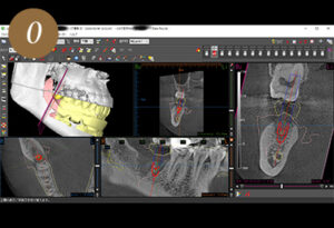 インプラント | 門前仲町髙木歯科