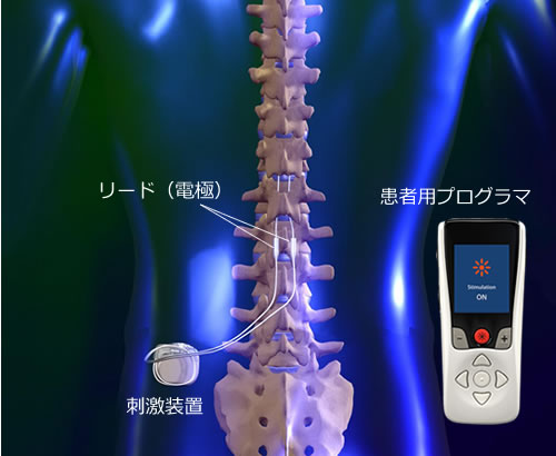 SCS治療（脊髄刺激療法） | パーキンソン病・慢性疼痛・神経障害性疼痛