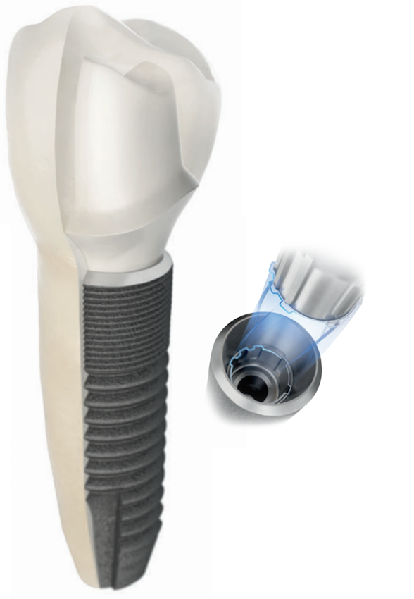 インプラント治療 - ひかりデンタルクリニック（岡崎市・額田郡幸田町）