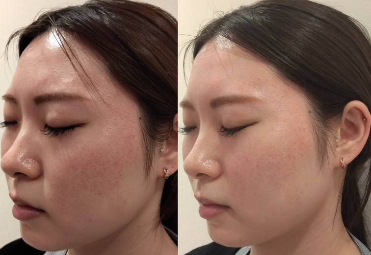 ジャンマリーニのロザリーブフェイスローション✨ ｜立川皮膚科