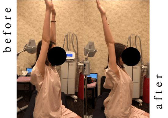 たった1回で大きな変化！胸郭・骨盤矯正器具「リアラインコア