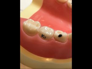 白いジルコニア乳歯冠 - 都筑キッズデンタルランド｜小児歯科専門