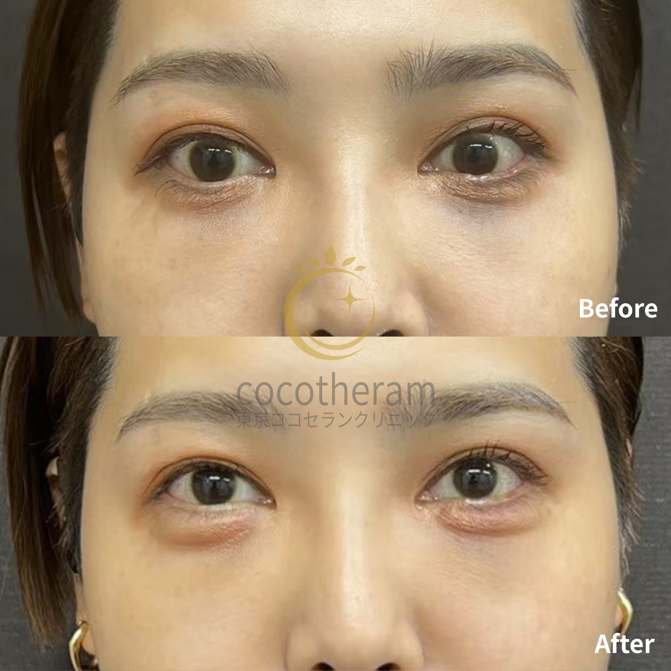 ジュビダーム | 施術メニュー | 池袋駅徒歩5分の美容外科・皮膚科