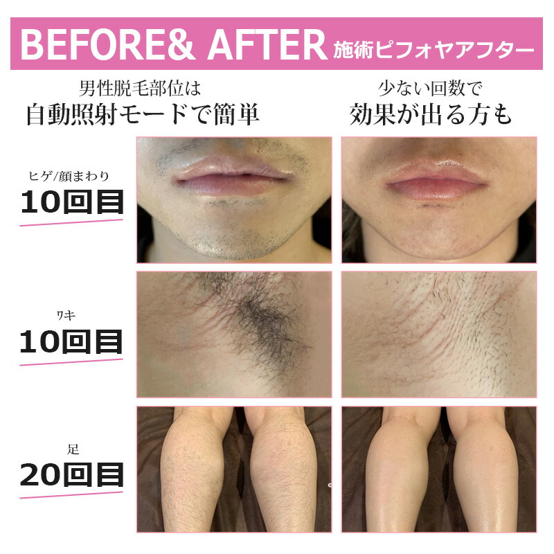 楽天市場】【見逃すな爆安セール限定価格19,800円】脱毛器 回数無限制