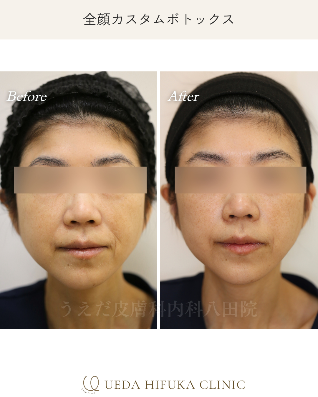 ボトックス注射 | うえだ皮膚科内科 八田院 | 名古屋市中川区
