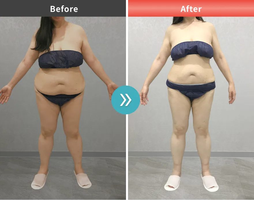 症例No.00134｜83.7kg→72.0kg（50代女性・161cm） - URARAクリニック