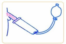 厚生労働省承認 陰圧式勃起補助器具VCD式カンキ