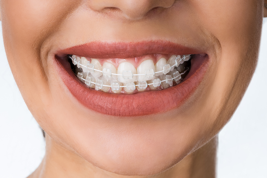 大人の矯正治療について – 茅ヶ崎駅の歯医者なら茅ヶ崎駅みやさか歯科