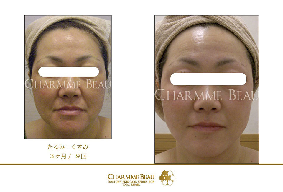 シャルム・ボー化粧品：フェイシャル：茨城県つくばのエステサロン