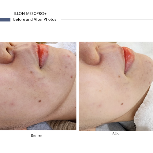 iLLON 【iLLON肌再生セット】MESOPRO®+&鎮静マスク / DOCTOR EXPRESS