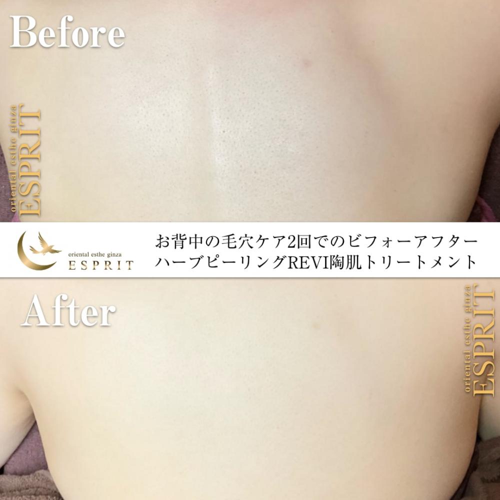 ハーブピーリングREVI【ルヴィ】陶肌トリートメント ｜東京銀座、新宿