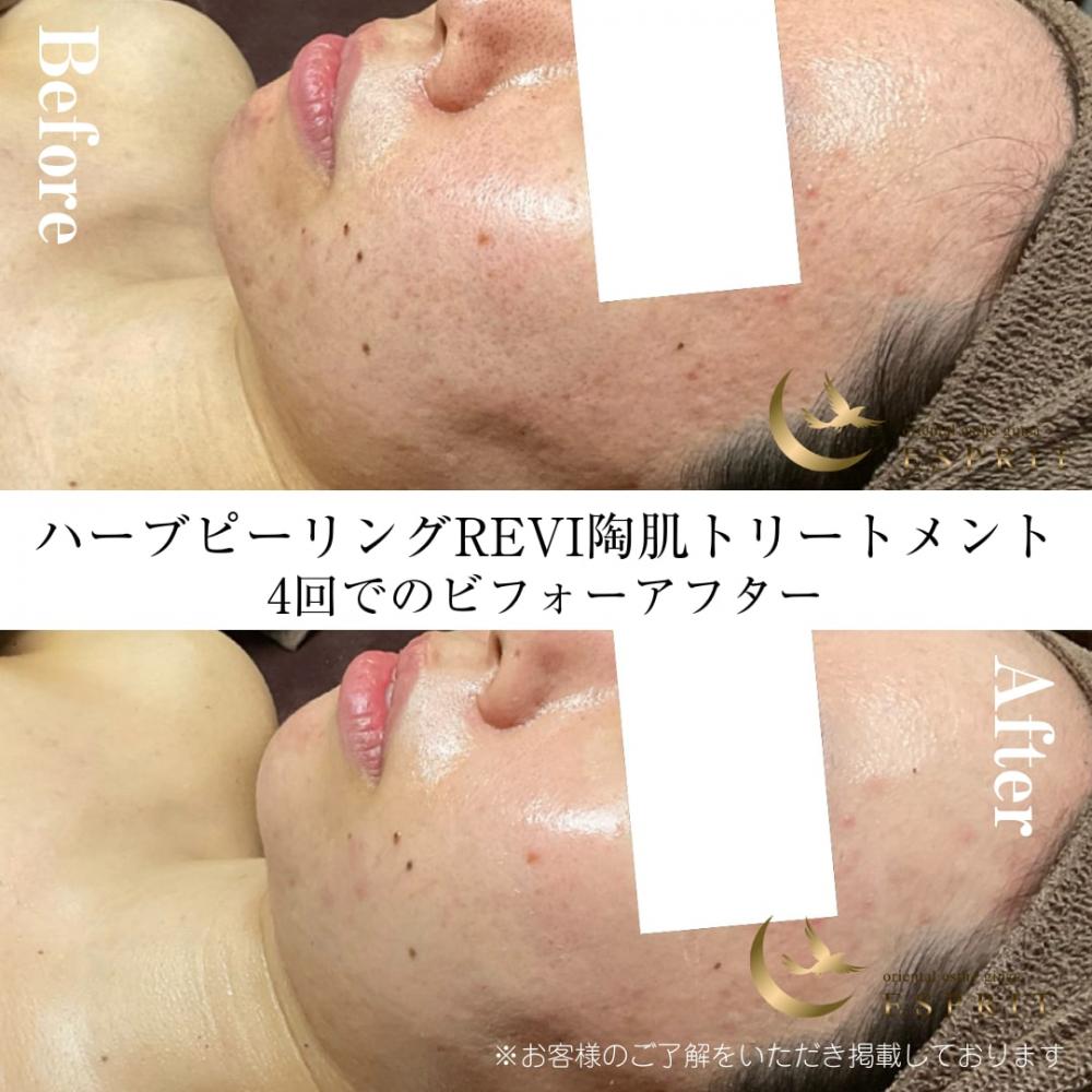 REVI陶肌トリートメントで“自分史上最高の素肌”へ！エスプリのビフォー