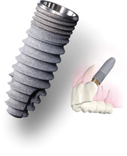 京セラのインプラント製品について