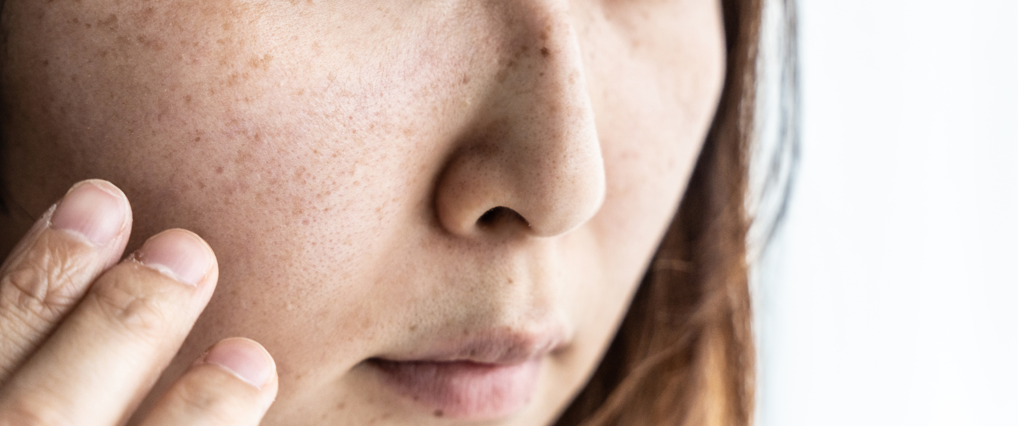 そばかすの消し方｜医師が解説する効果的な治療法とケアのポイント