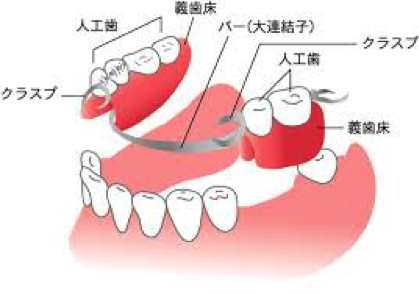 入れ歯（義歯） - ふなこし歯科医院