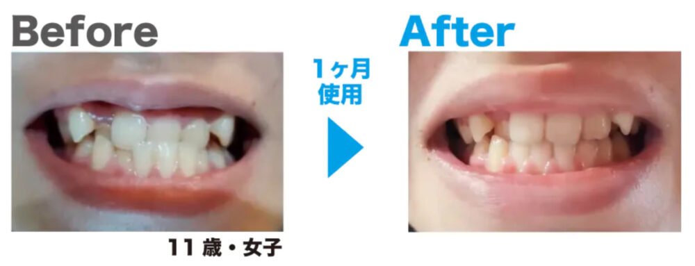 歯並びだけでなく全身の健康を高める「マウスピース369」を紹介！