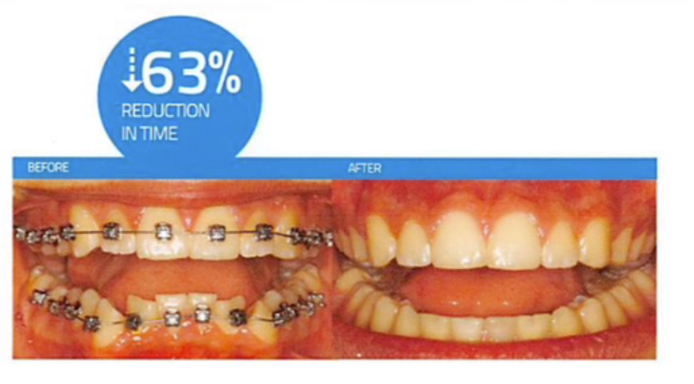 光加速装置「オーソパルス（OrthoPulse） - 仙台で矯正歯科治療が得意