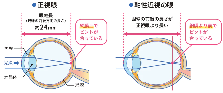 江東区亀戸｜お子様の近視進行を抑制するための治療