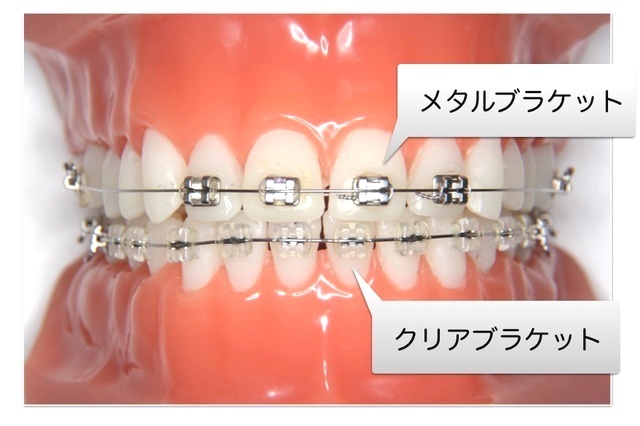 矯正装置 – かなやまクリニック