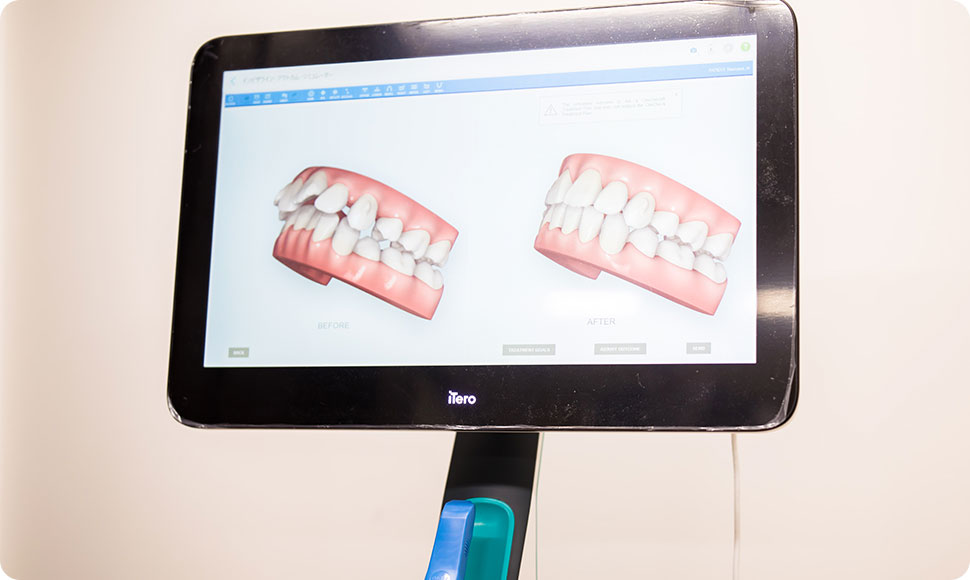 iTero（アイテロ）・PBMヒーリング｜京都（四条）のインビザライン