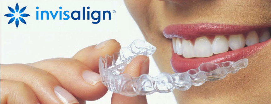 マウスピース矯正 新メニュー追加しました｜ブログ｜いちば歯科｜大阪