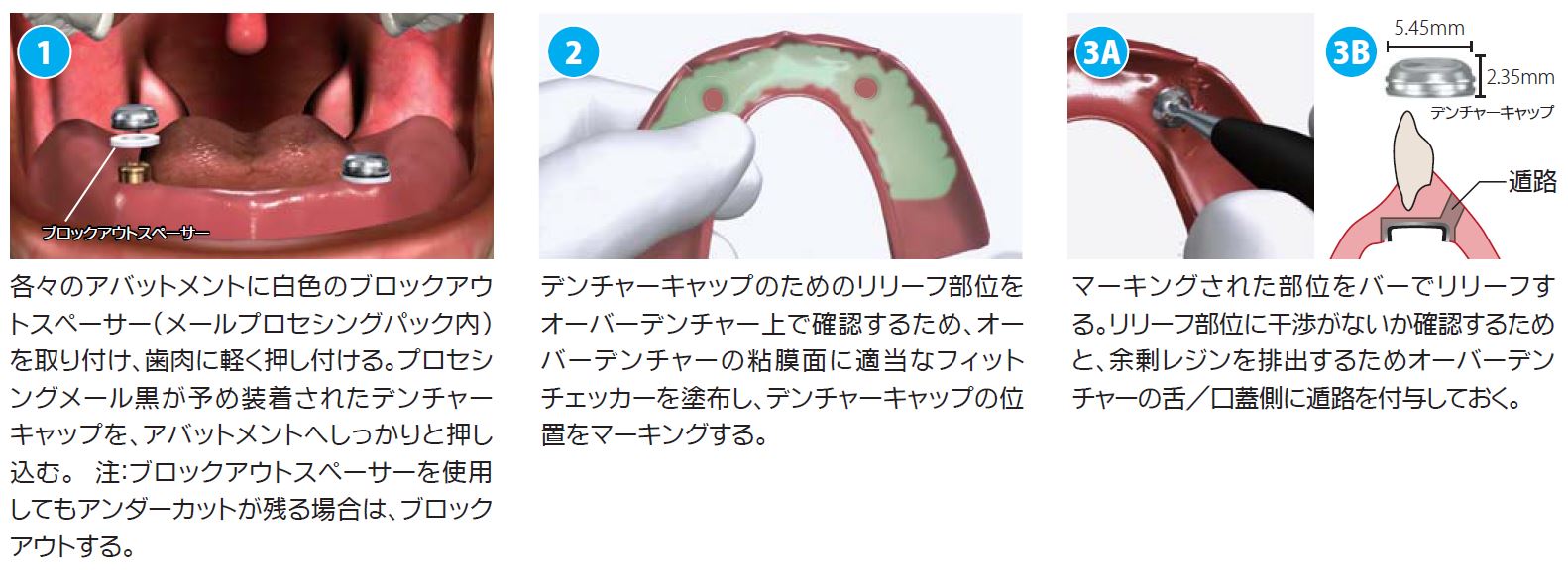 アバットメント(ロケーター）|株式会社インプラテックス