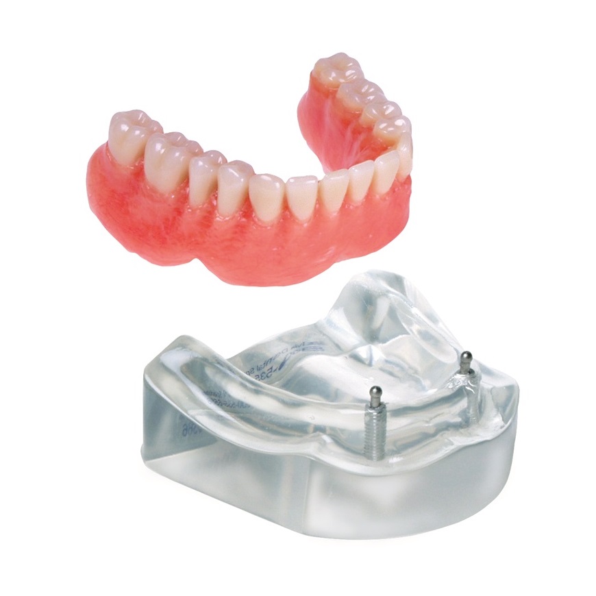 下顎インプラント模型 MOD D2-O｜株式会社インプラテックスの取扱い商品