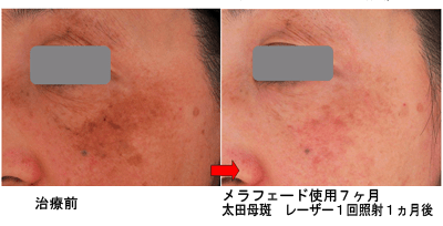 メラフェードでスキンケア｜京都・滋賀の大西皮フ科形成外科医院【大津