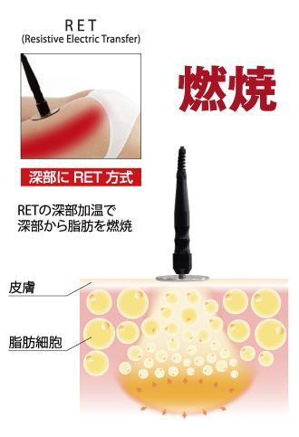 LastarのRAFOS Premium/ラフォスプレミアム（ラジオ波）について