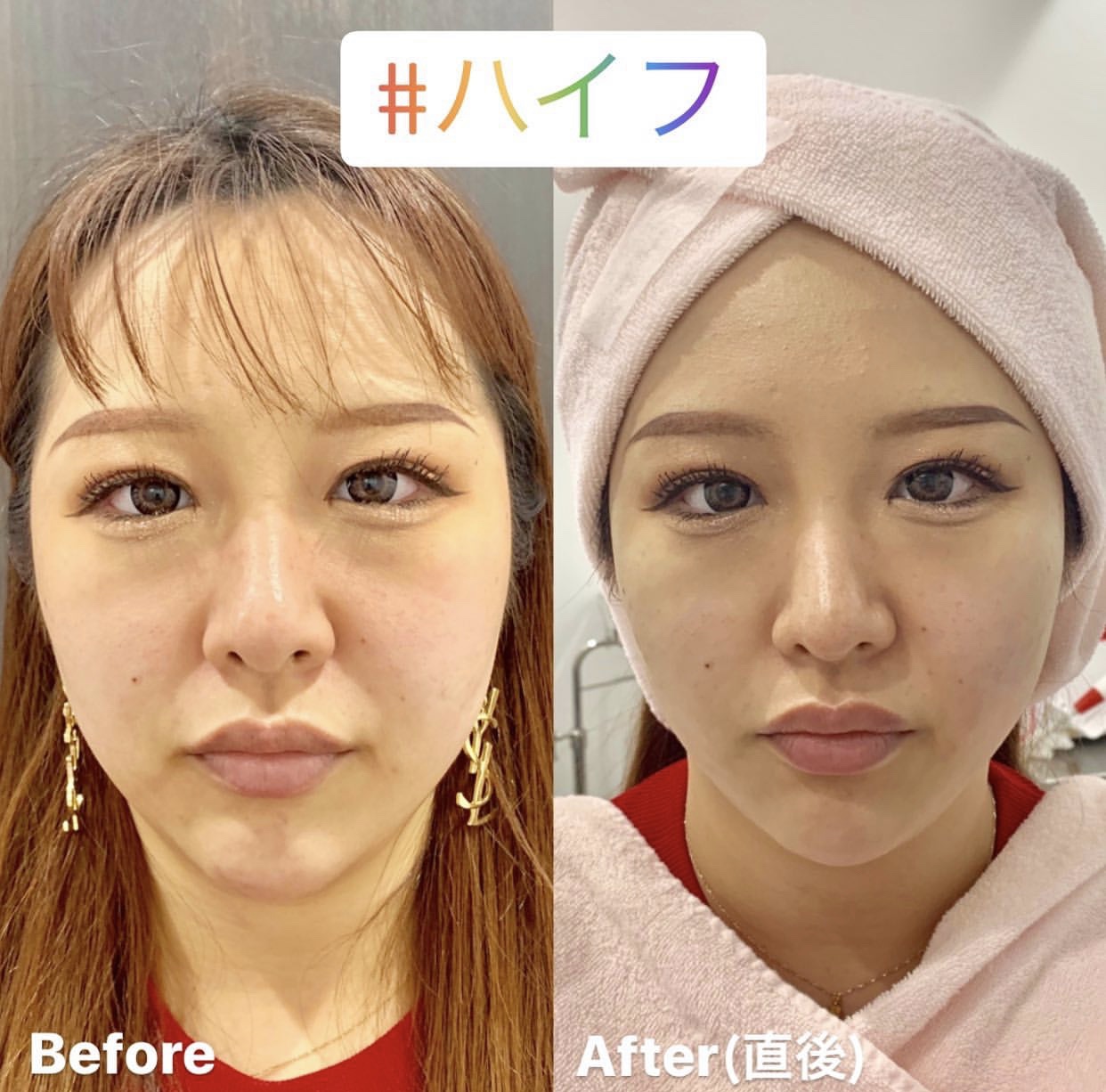 ソノクイーン ハイフ（HIFU）｜美容整形・美容皮膚科｜ルラ（LULA