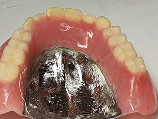 製作実績 | 町田技工 栃木市 義歯 歯科技工所 ノンスクラブデンチャー