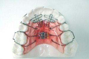 床矯正をもっと知ろう！！：治療について：矯正歯科｜堺（なかもず）の