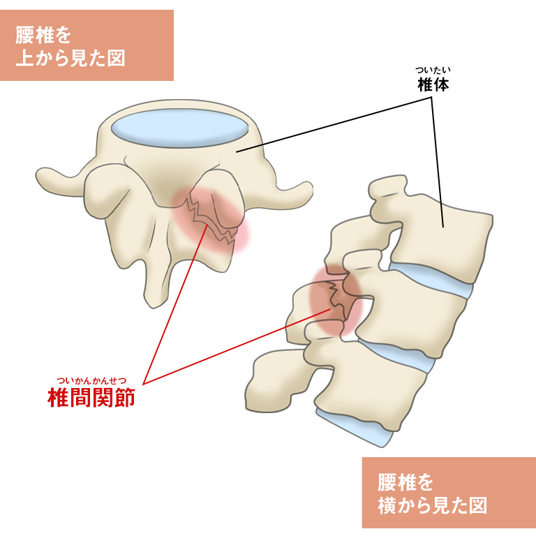 腰椎分離症 – McDavid｜サポータ－ブランドのマクダビッド