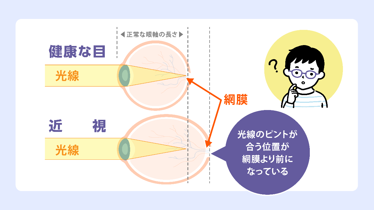 近視 | 目の病気と治療 | 眼科三宅病院（名古屋市北区）/ 大曾根駅から
