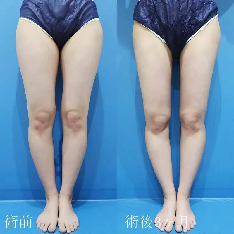 太もも・お尻の脂肪吸引 | 美容整形なら水の森美容クリニック【公式】