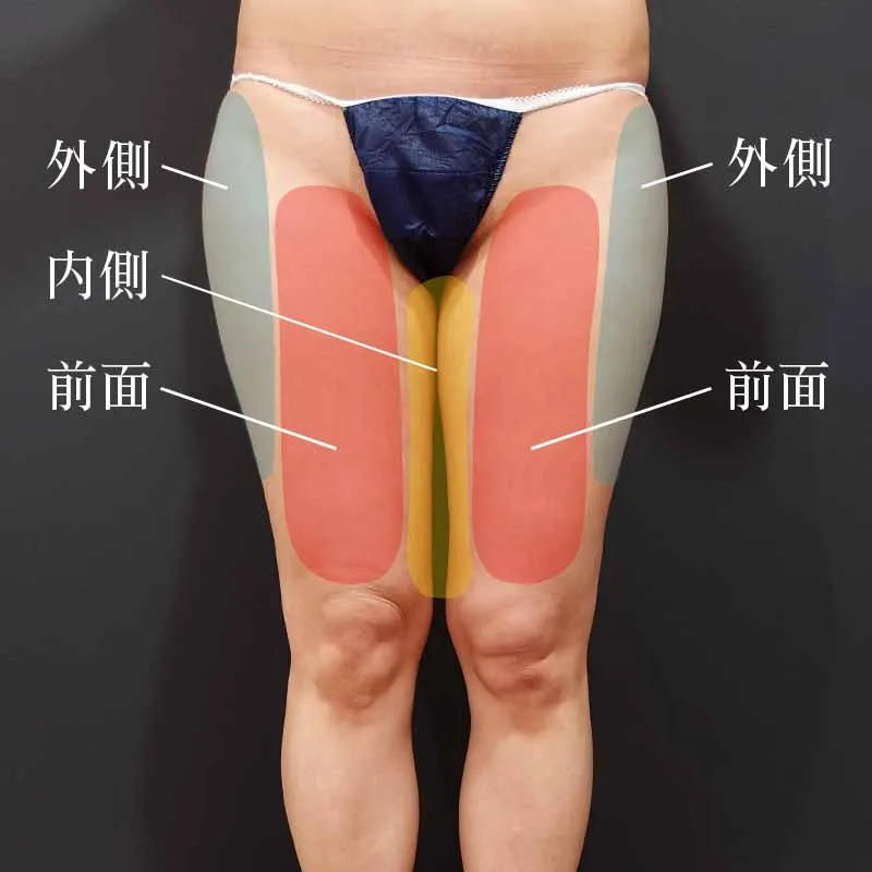 太もも・お尻の脂肪吸引 | 美容整形なら水の森美容クリニック【公式】