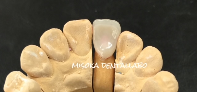 ジルコニアフレーム陶材築盛 | 晦日歯科技研│神奈川県相模原市の歯科