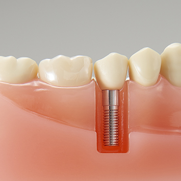 補綴物説明用模型 [PE-PRO019]｜株式会社ニッシン｜歯科模型・歯科材料