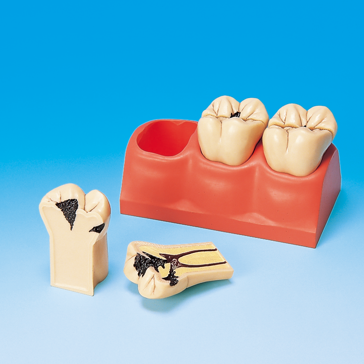 4倍大カリエス歯分割模型 [PE-TDS006(P13-TR.7)]｜株式会社ニッシン