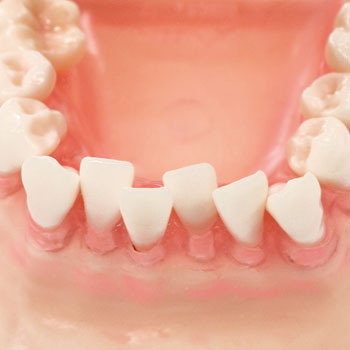 SRP実習用顎模型 [P15FE-MINT.1]｜株式会社ニッシン｜歯科模型・歯科