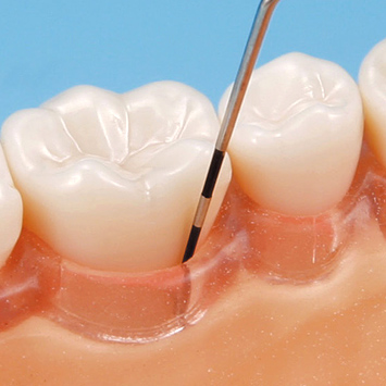 SRP用顎模型 [D16HD-500H(GSE)-MF](咬合器なし)｜株式会社ニッシン