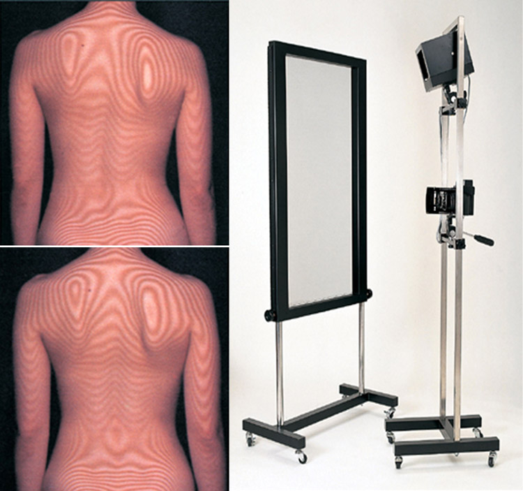 患者様インタビュー｜側弯症TOWN（患者向けサイト）｜日本側彎症（そく