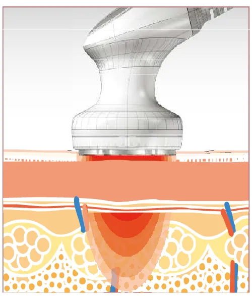 Beauty Pot (ビューティーポット) | 業務用複合痩身機