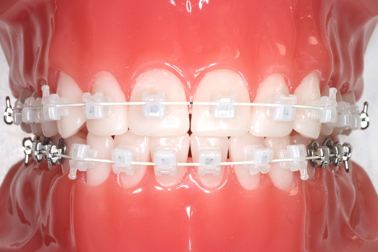 審美ブラケット｜自由が丘の歯医者 自由が丘シーズ歯科・矯正歯科