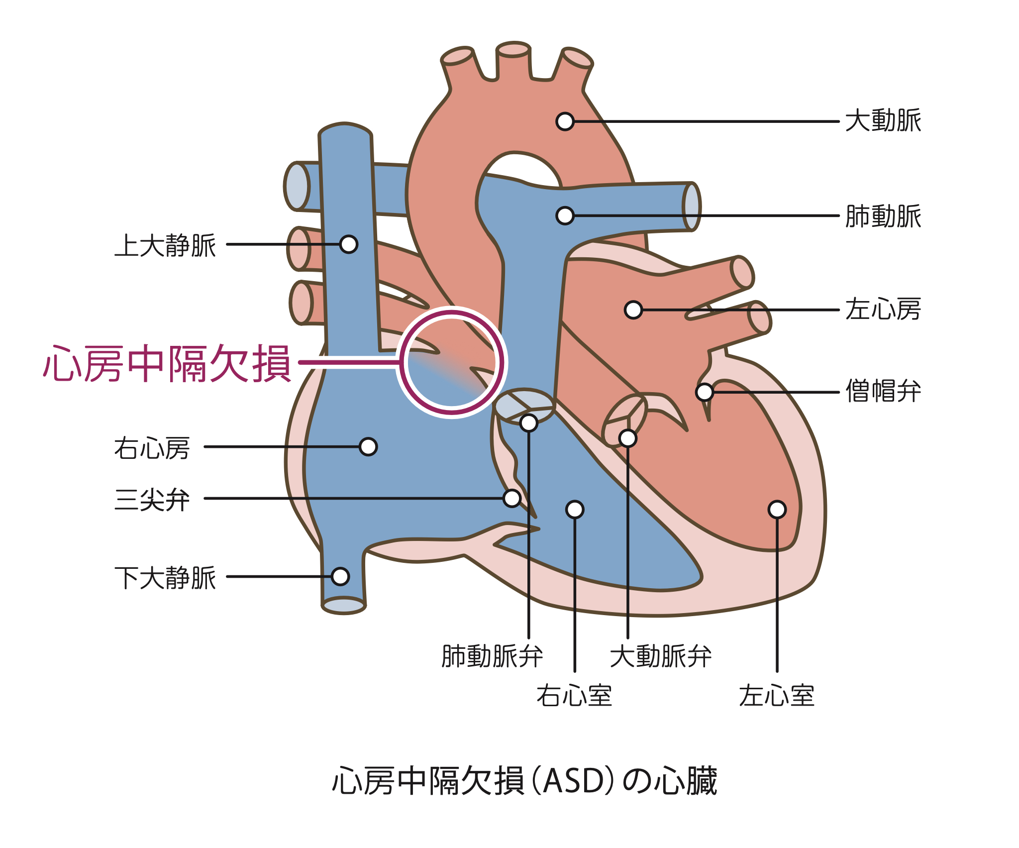 心房中隔欠損症の経皮的閉鎖 | 循環器内科 | 仙台厚生病院
