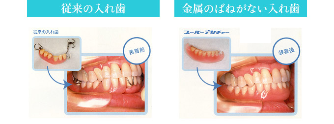 GDS方式の入れ歯(義歯)作成｜四季デンタルクリニック 栃木県 鹿沼市