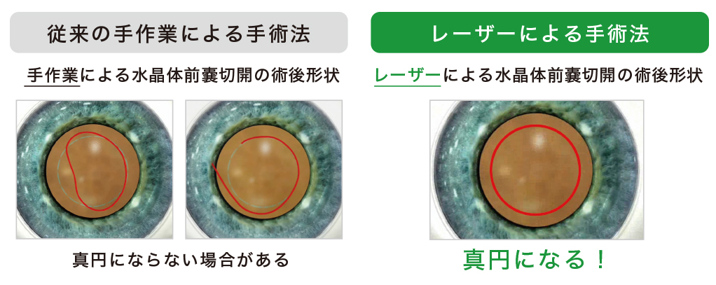 レーザー白内障手術｜ICL（眼内コンタクトレンズ）・レーシックで視力